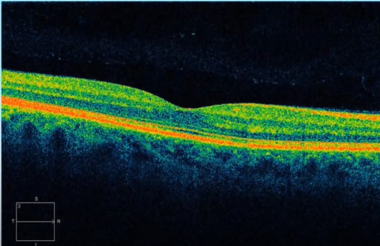 tomografía de coherencia óptica OCT retina glaucoma óptica val santiago de compostela